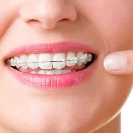 Custom Braces - as easy as clear aligners!